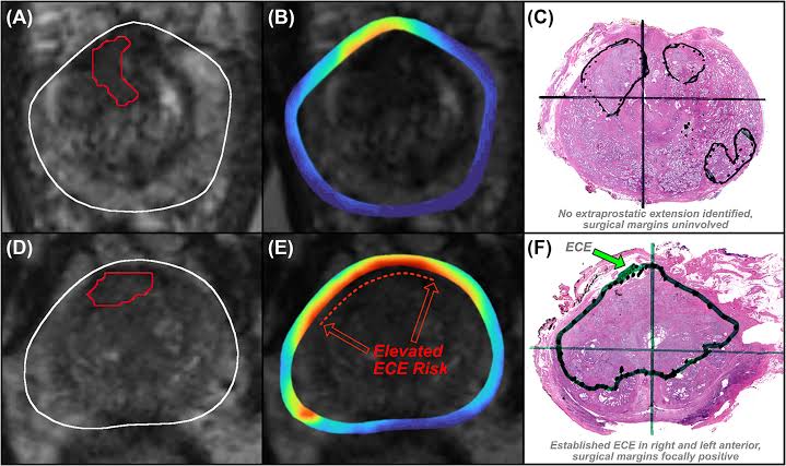 AI Maps Prostate Cancer in 3D to Guide Surgeons in Real-Time