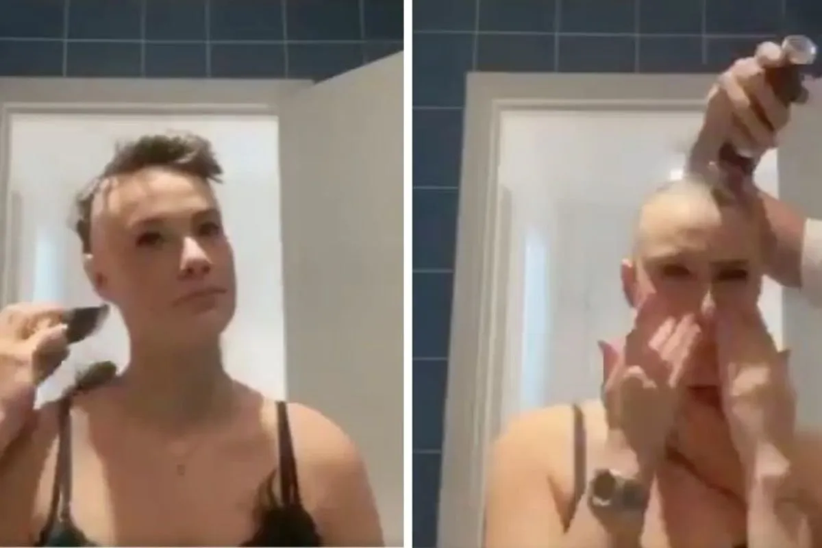 Boyfriend Shaves Head in Solidarity with Alopecia Girlfriend