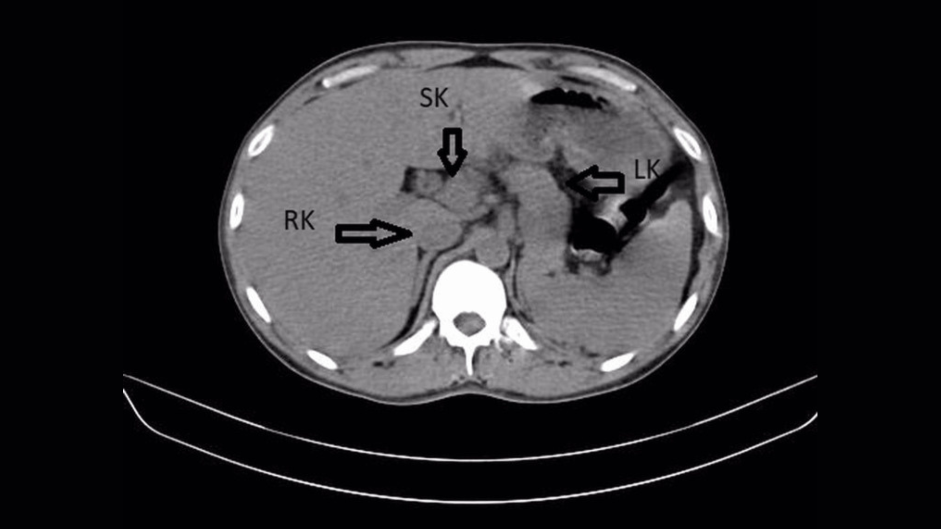 Man Treated for UTI Discovers He Has Three Kidneys
