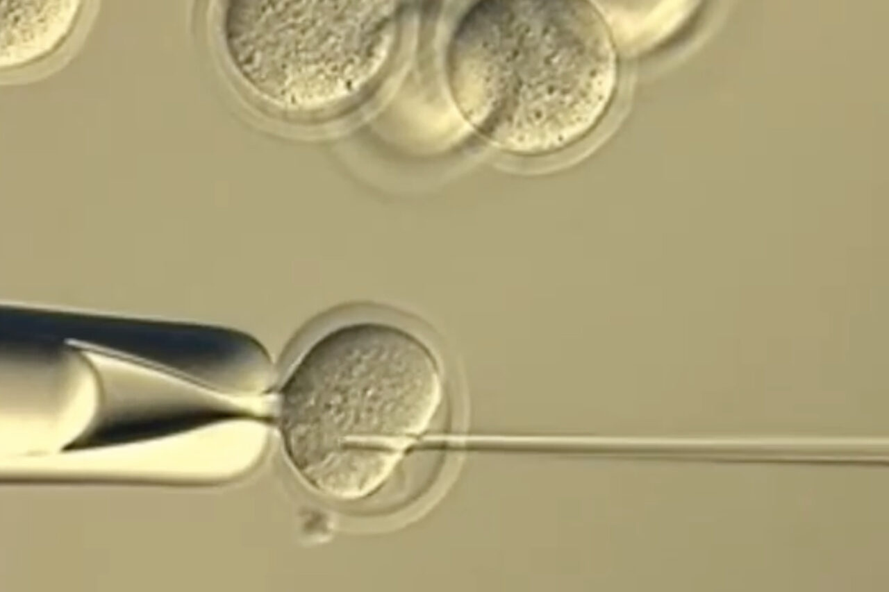 Scientists Silence Extra Chromosome in Down Syndrome Cells - Image 5