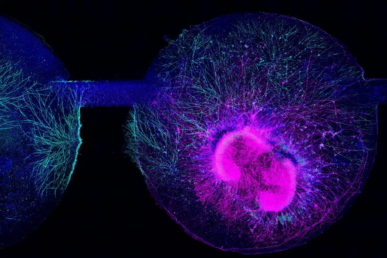 Stem Cell Patch Lets Spina Bifida Kids Walk and Run - Image 3