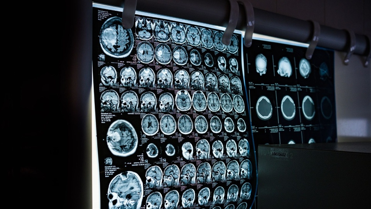 Scientists Find New Way Brain Cells Die in Alzheimer's
