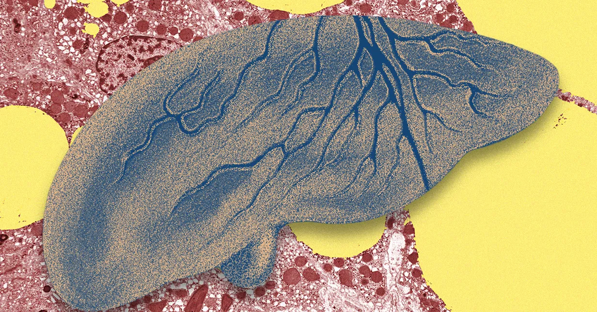 AI Spots Fatty Liver Disease Early, Saving Lives