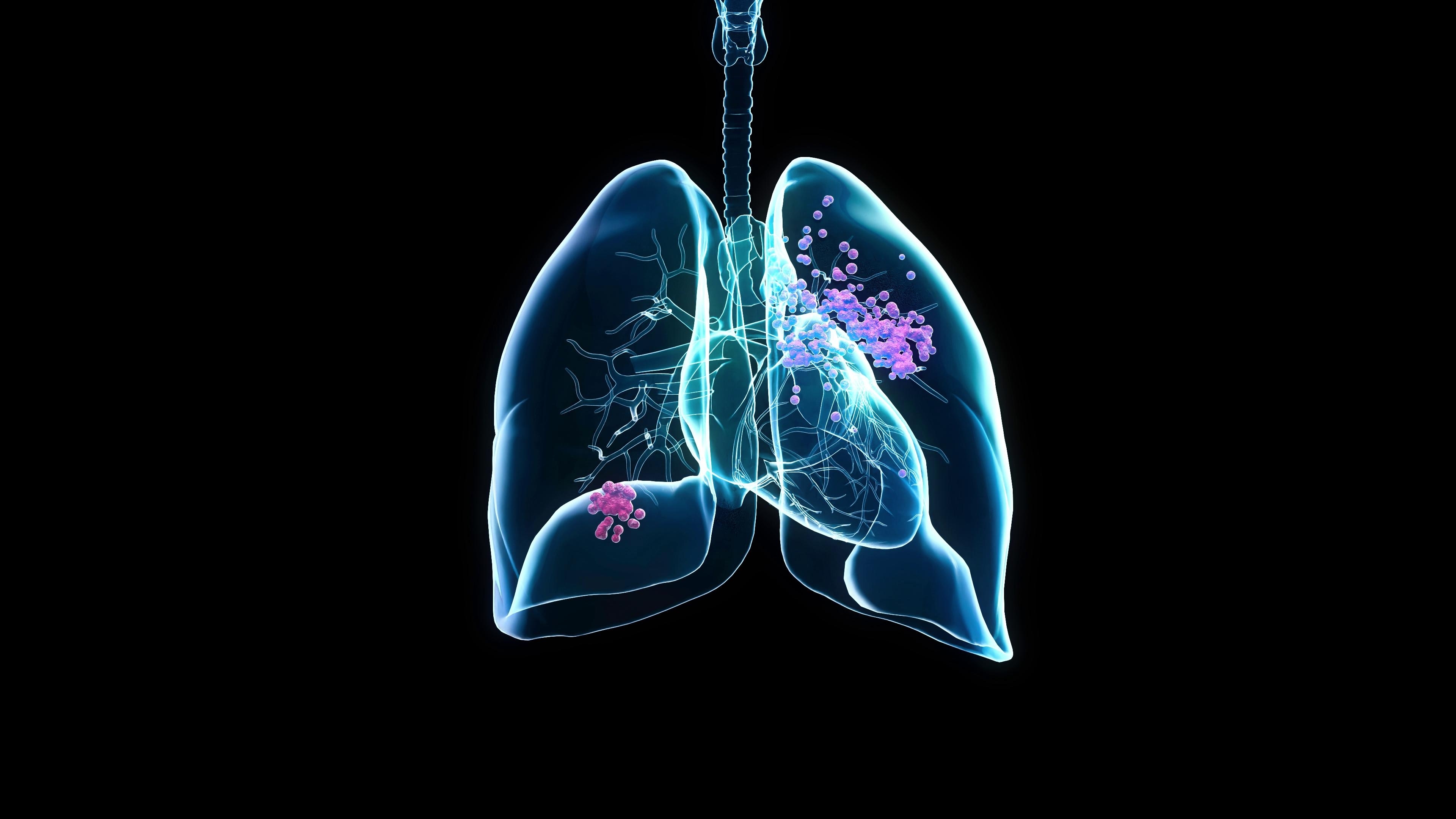 FDA Approves New Drug for Resistant Lung Cancer Patients