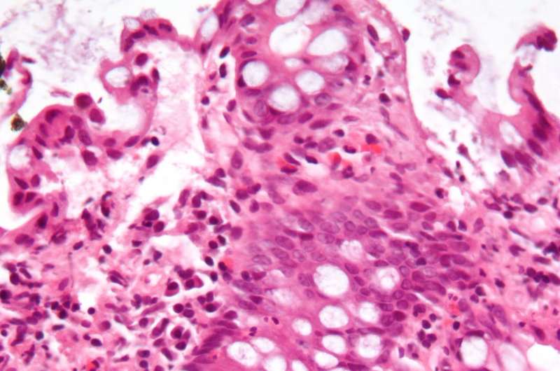 New Drug Reverses Gut Disease Linked to Blood Mutations - Image 3