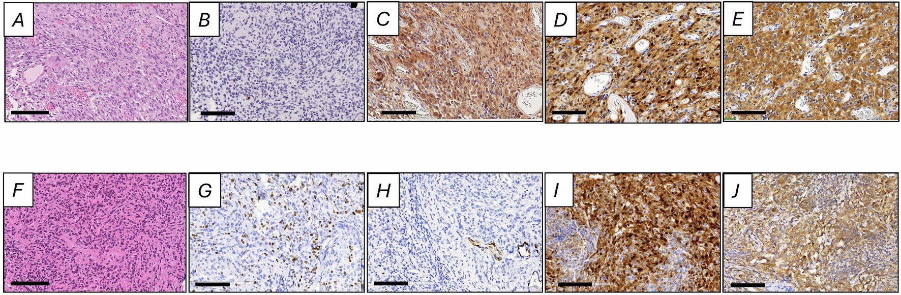Oral Drug Shows Promise Against Deadly Brain Tumors