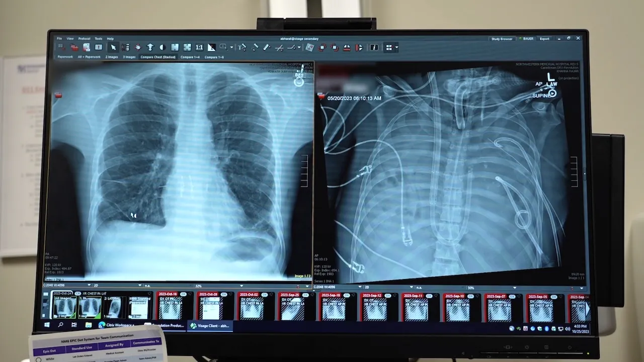 Surgeons Keep Man Alive 48 Hours Without Lungs