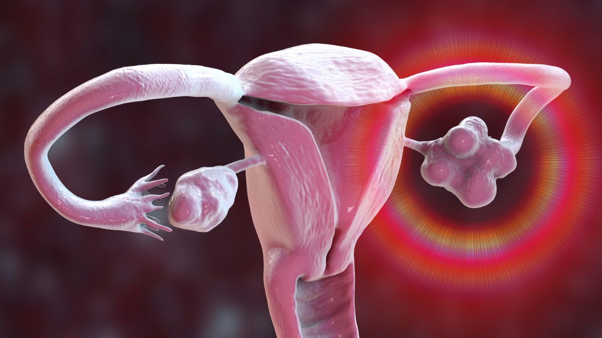 PCOS Renamed After 90 Years of Misleading Women Worldwide