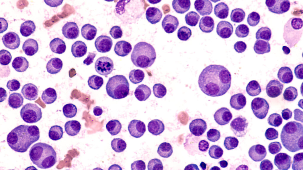 Medical researcher examining CAR-T immunotherapy cells under microscope in cancer research laboratory