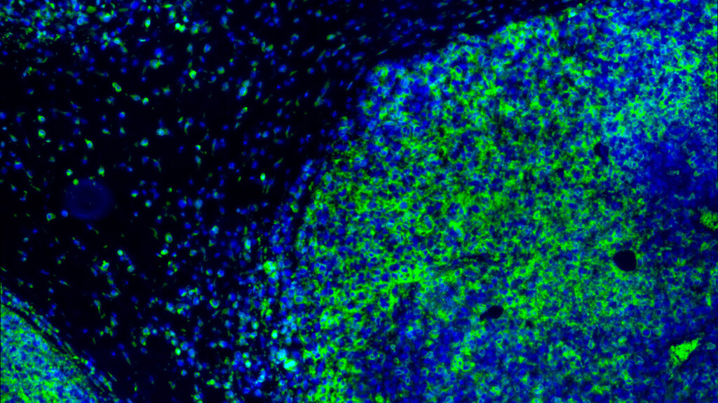After 15 Years of Failures, Cancer Drug Shows Real Promise